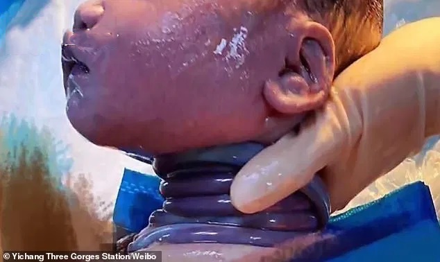 Vừa chào đời, bé trai khiến tất cả bác sĩ tập trung lại để đếm số vòng dây rốn quấn cổ-1