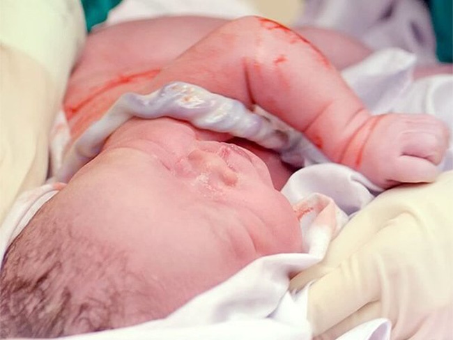 Vừa chào đời, bé trai khiến tất cả bác sĩ tập trung lại để đếm số vòng dây rốn quấn cổ-4