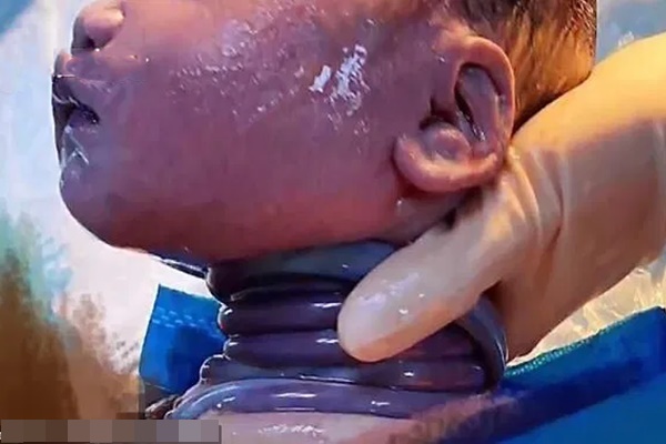 Hiếm gặp: Bé trai chào đời với 4 vòng dây rốn quấn cổ bằng phương pháp sinh thường-3