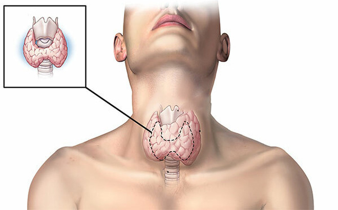 Sau 25 năm ăn muối iốt, bệnh tuyến giáp bùng phát tại TQ: Sai lầm lớn rất nhiều người mắc-1