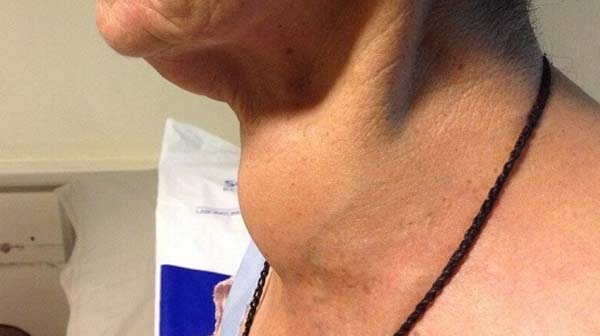 Sau 25 năm ăn muối iốt, bệnh tuyến giáp bùng phát tại TQ: Sai lầm lớn rất nhiều người mắc-2