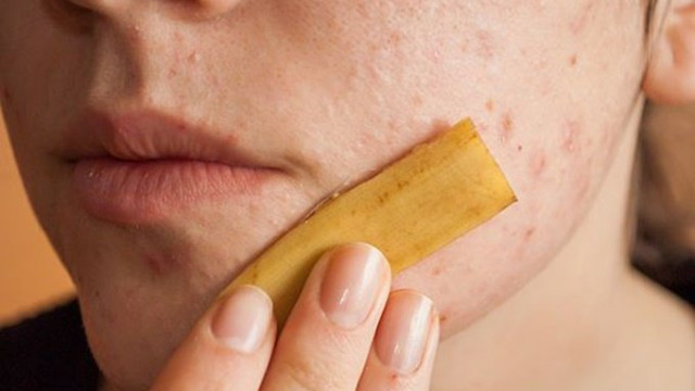 Không cần mỹ phẩm đắt tiền, miếng vỏ chuối bạn vứt đi lại là thần dược chống lão hóa, diệt mụn nhọt, nám da chỉ trong 1 tuần-3