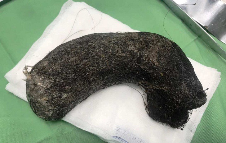 Phát hiện búi tóc khủng nặng 1kg ở trong dạ dày bé gái 11 tuổi-1