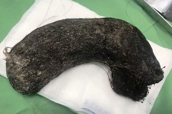 Phát hiện búi tóc