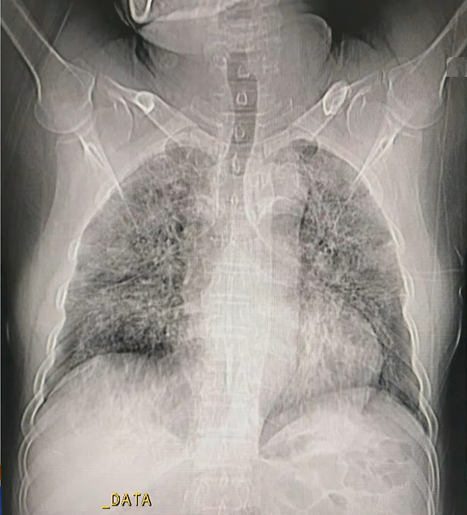 Hình ảnh phổi người mắc Covid-19 ở Việt Nam-1