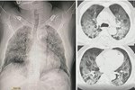BV Bệnh Nhiệt đới Trung ương: 3 bệnh nhân COVID-19 tiến triển rất nặng, BN812 bị tổn thương 70% chức năng phổi-2