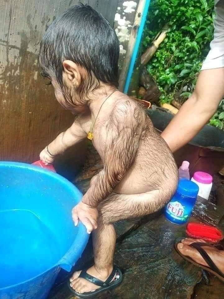 Xót xa nhìn bé trai với vẻ ngoài kì lạ, khắp người phủ kín đầy lông-1