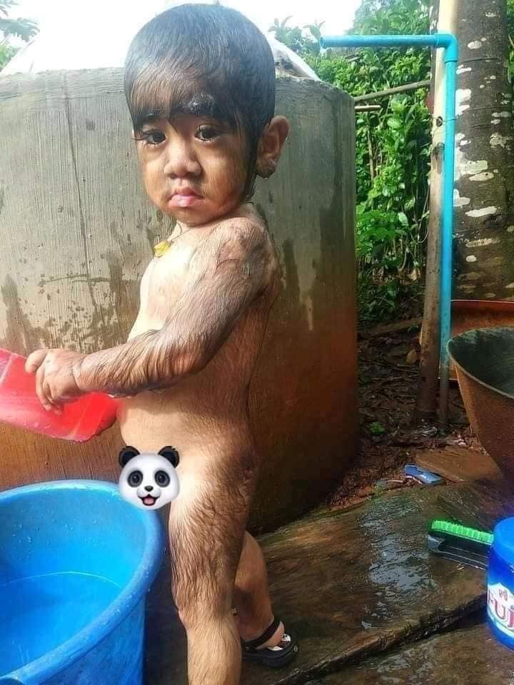 Xót xa nhìn bé trai với vẻ ngoài kì lạ, khắp người phủ kín đầy lông-2