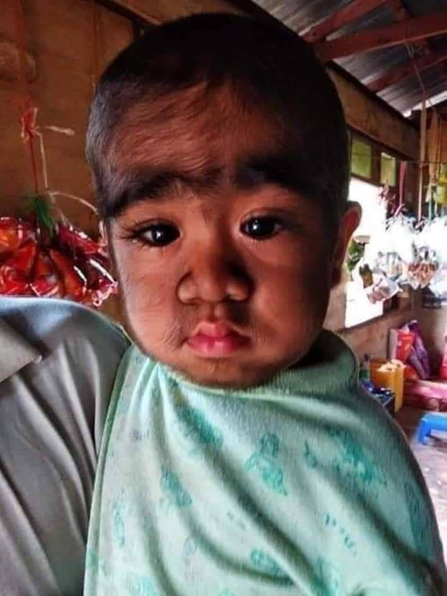 Xót xa nhìn bé trai với vẻ ngoài kì lạ, khắp người phủ kín đầy lông-4