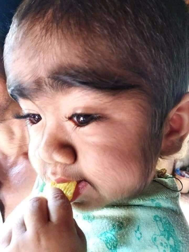 Xót xa nhìn bé trai với vẻ ngoài kì lạ, khắp người phủ kín đầy lông-5