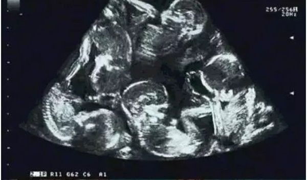 Mừng rỡ khi biết mình mang thai đôi, đến tháng thứ 5, bà mẹ chết sững khi nhìn vào màn hình siêu âm-1