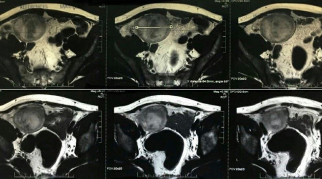 Lạc tinh hoàn trong ổ bụng không hề hay biết, 44 năm sau người đàn ông bị ung thư tinh hoàn-1