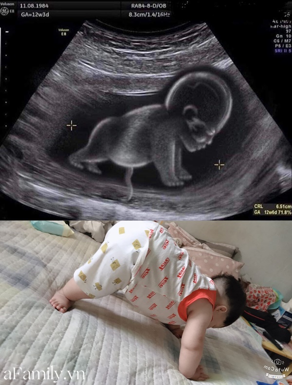 Thực hư bức ảnh siêu âm chụp thai nhi trong tư thế biết tập gym từ khi còn nằm trong bụng mẹ-1