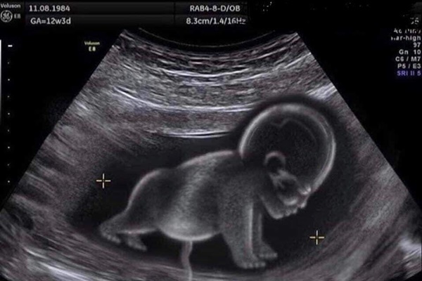 Chào đời với khối u lớn gấp rưỡi cơ thể, nhưng chỉ 1 năm sau ai nhìn em bé cũng bất ngờ-6