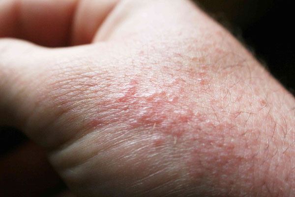 Sốc: Tìm thấy virus SARS-CoV-2 trong da người!-1