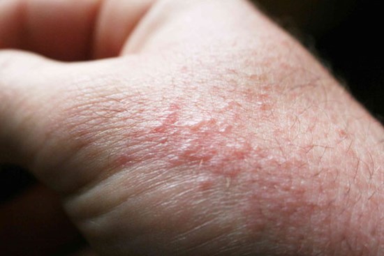 Sốc: Tìm thấy virus SARS-CoV-2 trong da người!