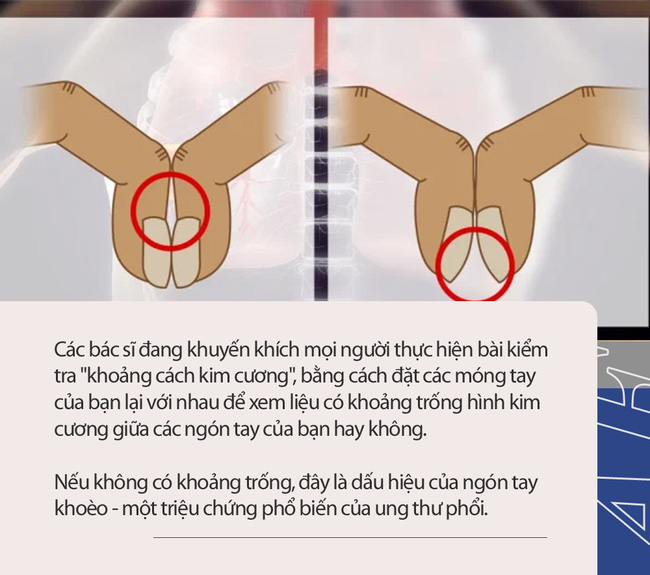 Bài kiểm tra đơn giản bằng 2 ngón tay có thể cho biết liệu bạn có nguy cơ bị ung thư phổi hay không-1
