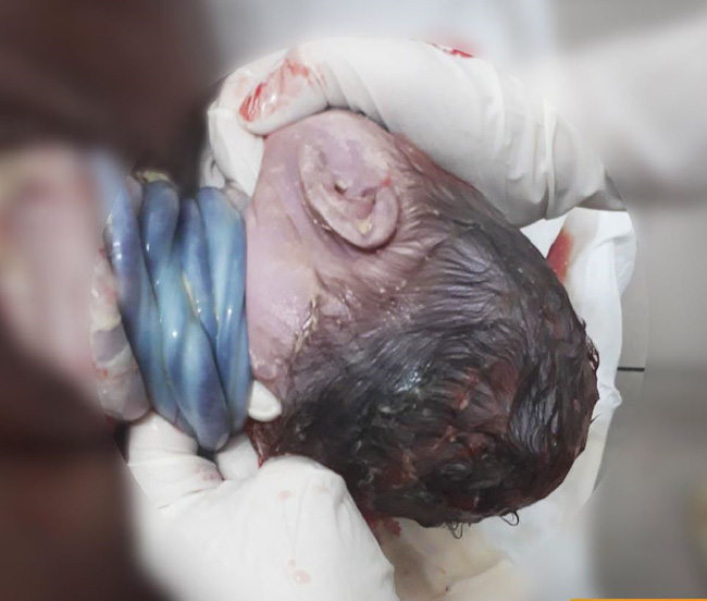 Hiếm gặp: Bé trai chào đời với 4 vòng dây rốn quấn cổ bằng phương pháp sinh thường-1