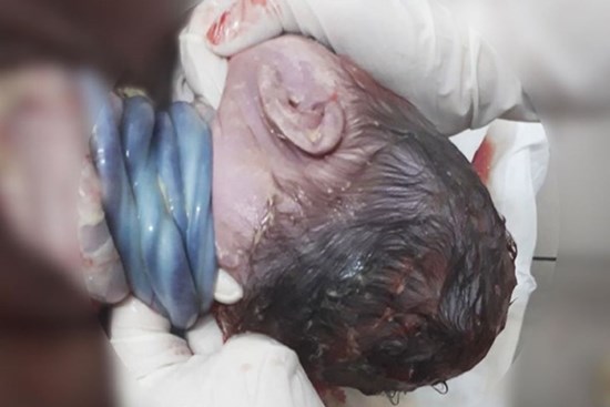 Hiếm gặp: Bé trai chào đời với 4 vòng dây rốn quấn cổ bằng phương pháp sinh thường