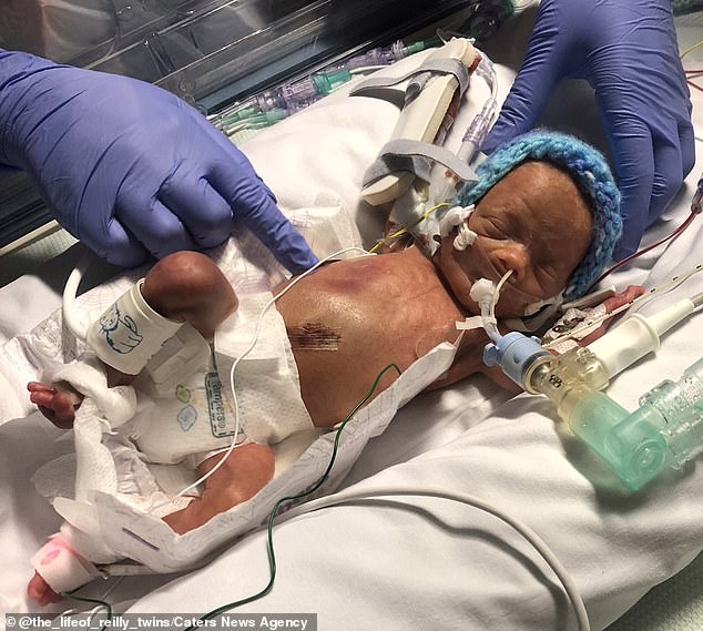 Đang chuyển dạ thì hết đau đẻ, bà mẹ bầu thai đôi sinh 2 con cách nhau hẳn 2 ngày-1