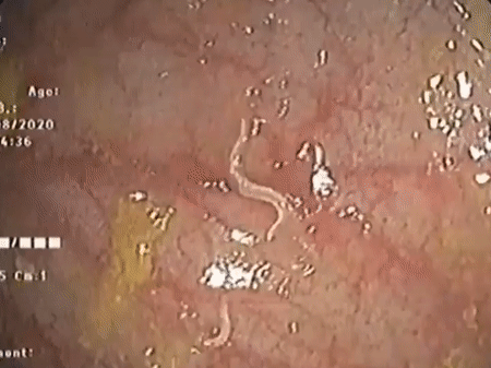 Rùng mình nhìn giun kim lúc nhúc trong đại tràng bé trai, bố mẹ đã nhớ lịch tẩy giun định kì cho con hay chưa?-1