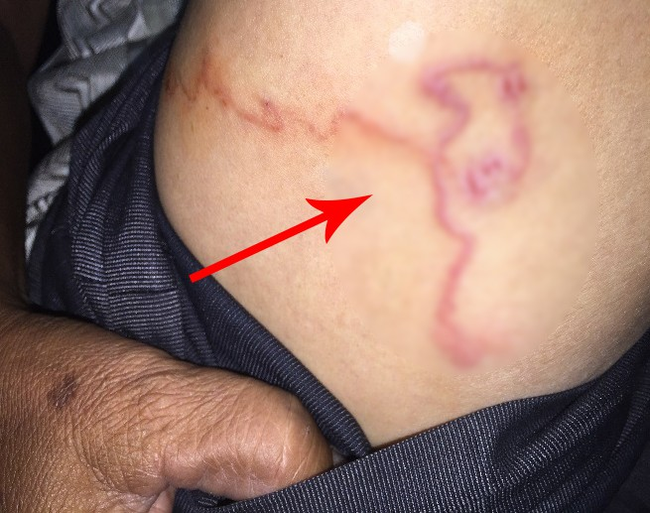 Rùng mình nhìn giun kim lúc nhúc trong đại tràng bé trai, bố mẹ đã nhớ lịch tẩy giun định kì cho con hay chưa?-2