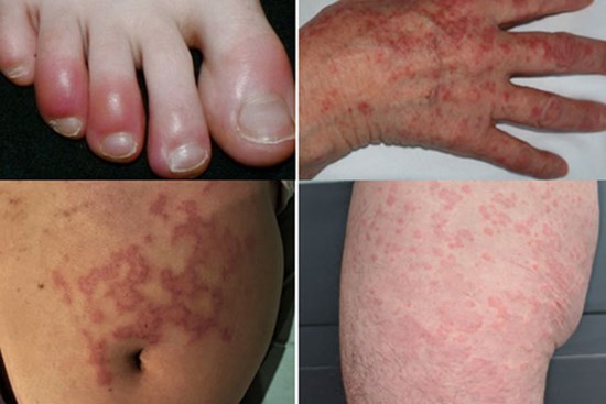 Năm dấu hiệu trên da cảnh báo bạn có thể mắc Covid-19