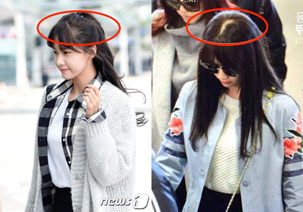 Sấy tóc như Yoona bảo sao tóc cô cứ rụng, mỏng dính lộ cả mảng da đầu: Chị em cũng nên cẩn thận đừng mắc sai lầm này-1