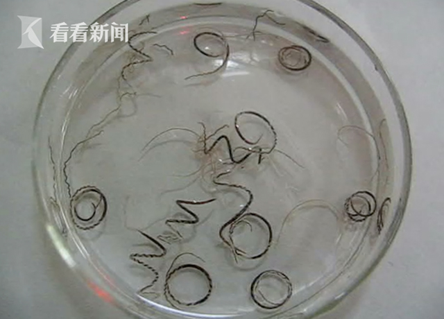 Vì thói quen uống nước tai hại này, chàng trai 26 tuổi đã nhiễm ký sinh trùng trong não, cả thế giới có 3000 ca mắc bệnh như vậy-3