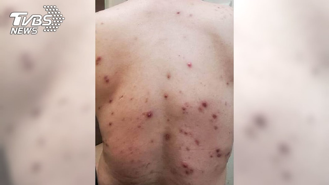 Nam thanh niên 25 tuổi bỗng dưng nổi đầy mụn ở mặt và lưng, nghe bác sĩ nói anh mới biết mình đã sai quá sai khi dùng loại đồ uống này-1