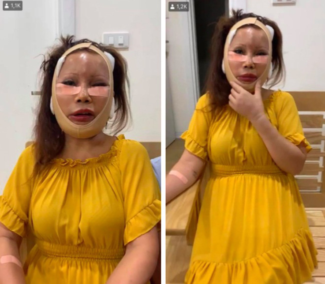 Cô dâu 63 tuổi ở Cao Bằng sau 2 tháng phẫu thuật căng da mặt, diện mạo khiến ai cũng đồng ý là dao kéo hỏng”-1