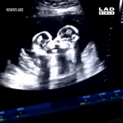 Khoảnh khắc siêu âm hiếm hoi ghi lại cú chạm nhau của 2 thai nhi song sinh trong bụng mẹ-1