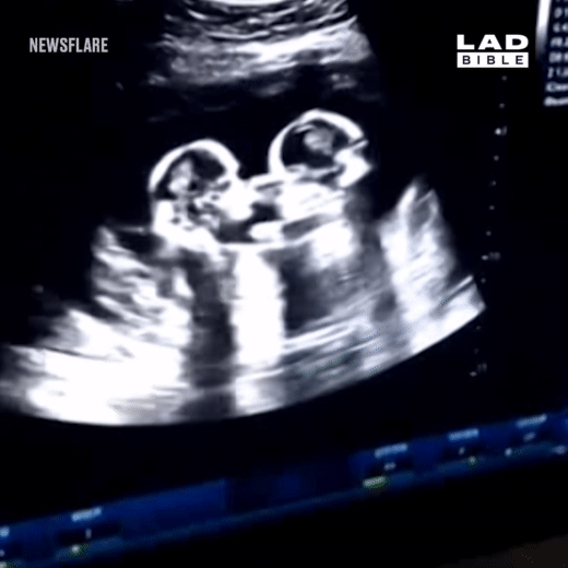 Khoảnh khắc siêu âm hiếm hoi ghi lại cú chạm nhau của 2 thai nhi song sinh trong bụng mẹ-2