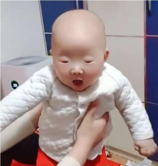 Em bé kỳ lạ sinh ra với đôi mắt nhỏ đến khó tin, dân mạng đi tìm nguyên nhân-4