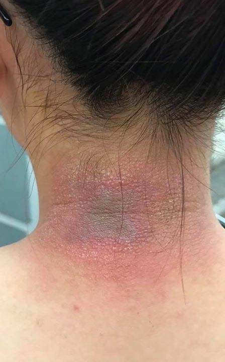 Cách xử lý kịp thời, hiệu quả hạn chế vết thương đau rát khi bị kiến ba khoang đốt-3