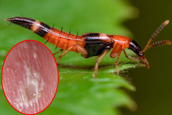 Gần 100 người nhập viện mỗi ngày vì tiếp xúc với kiến ba khoang-3