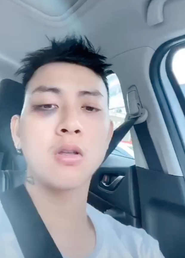 Rò rỉ clip Hoài Lâm bầm tím cả vùng mắt và dính nghi vấn tâm lý không ổn định-1