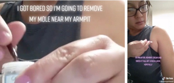 Bác sĩ cảnh báo một trào lưu trên TikTok nguy hiểm có thể gây tổn thương da vĩnh viễn-1