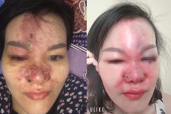 Tai nạn thẩm mỹ gây 
