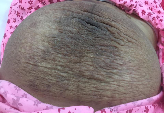 Mang thai 3 cực hiếm gặp, mẹ 9x bụng rạn chi chít ai cũng sợ không vác nổi, đẻ xong còn khủng khiếp hơn-10