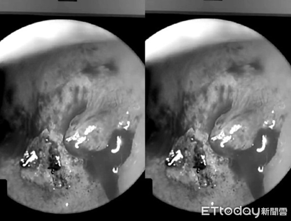 Đang lên đỉnh bỗng chảy máu mũi nửa tiếng không hết, lý giải của bác sĩ còn bất ngờ hơn-1