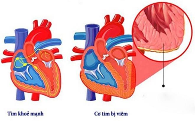 Bệnh nhân COVID-19 đã hồi phục vẫn có thể bị ảnh hưởng tim-1