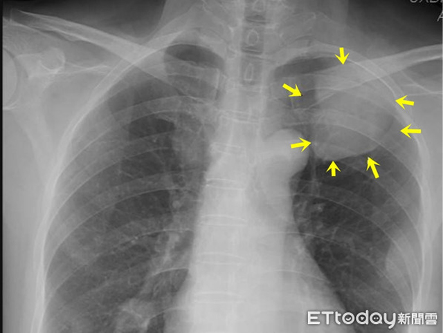 Chỉ bị co giật ở vai phải, đến bệnh viện khám, người phụ nữ sốc nặng khi được chẩn đoán ung thư giai đoạn cuối-1