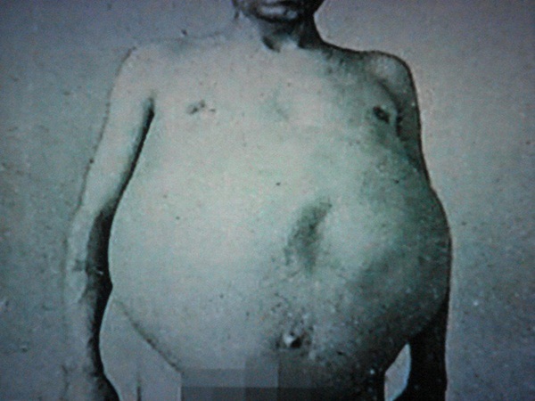 Chuyện kỳ lạ về người đàn ông bị táo bón bẩm sinh, chết khi cố đi đại tiện và ruột già được trưng bày trong bảo tàng Mỹ gây sởn da gà-1