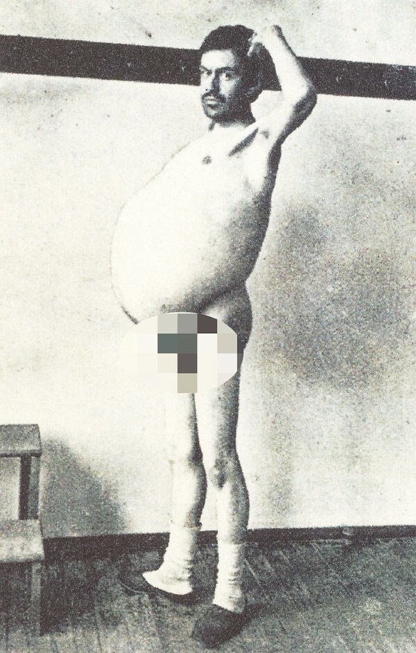 Chuyện kỳ lạ về người đàn ông bị táo bón bẩm sinh, chết khi cố đi đại tiện và ruột già được trưng bày trong bảo tàng Mỹ gây sởn da gà-3