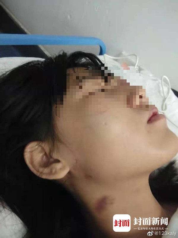 Người phụ nữ ôm gương mặt bê bết máu chạy đến bệnh viện, tiết lộ bi kịch bạo hành gia đình suốt 5 năm và suýt bị chồng chôn sống-2