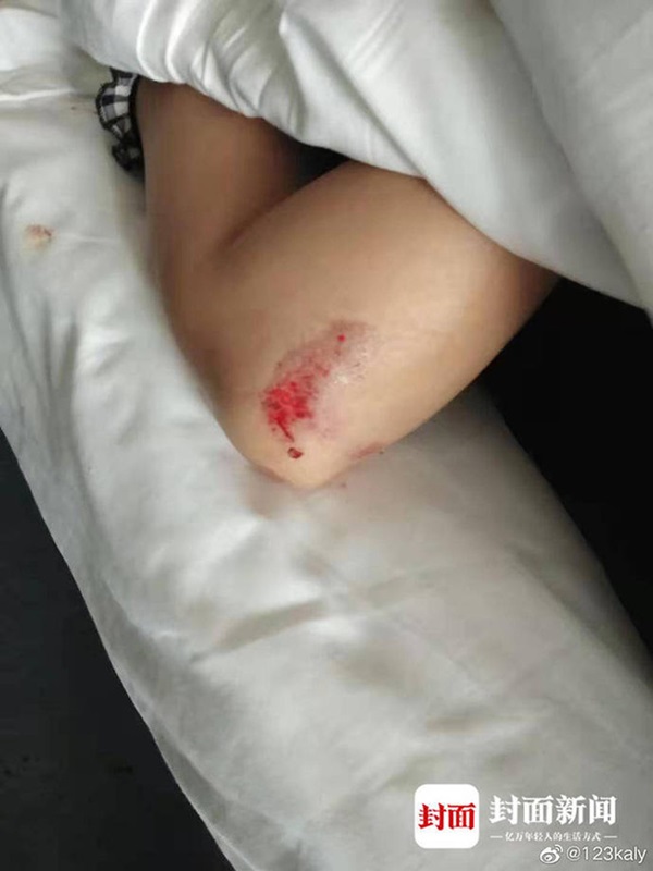 Người phụ nữ ôm gương mặt bê bết máu chạy đến bệnh viện, tiết lộ bi kịch bạo hành gia đình suốt 5 năm và suýt bị chồng chôn sống-3