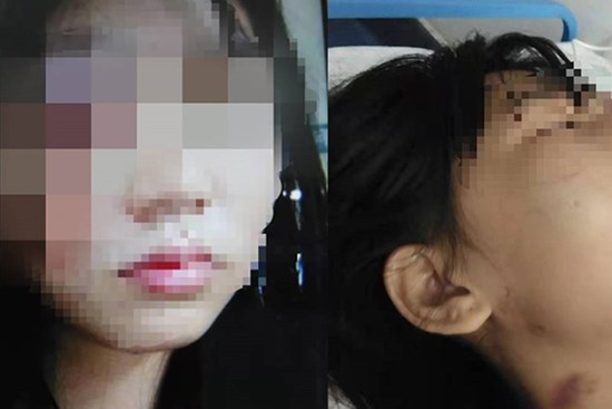 Người phụ nữ ôm gương mặt bê bết máu chạy đến bệnh viện, tiết lộ bi kịch bạo hành gia đình suốt 5 năm và suýt bị chồng chôn sống