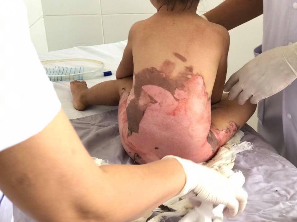 Ngã vào chậu nước sôi khi chuẩn bị tắm, bé gái bị bỏng nặng nhiều vùng trên cơ thể-1