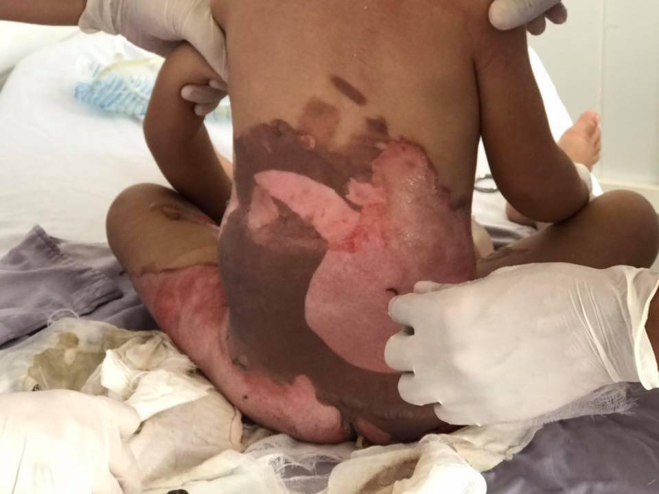 Ngã vào chậu nước sôi khi chuẩn bị tắm, bé gái bị bỏng nặng nhiều vùng trên cơ thể-2